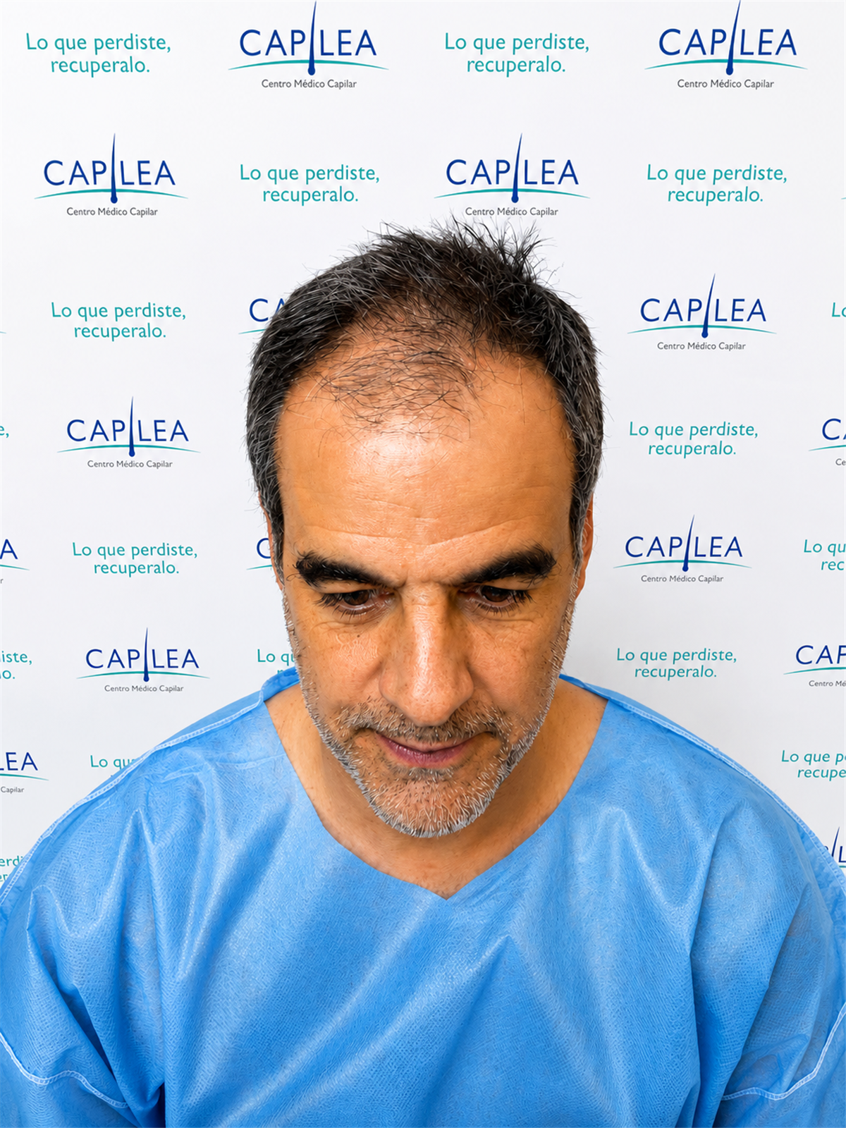 Antes del implante capilar
